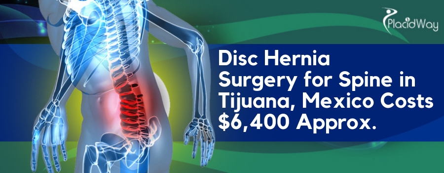 Disc Hernia Surgery in Tijuana, Mexico Cost